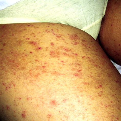 Diffuse Maculopapular Rash That Appeared Simultaneously With High