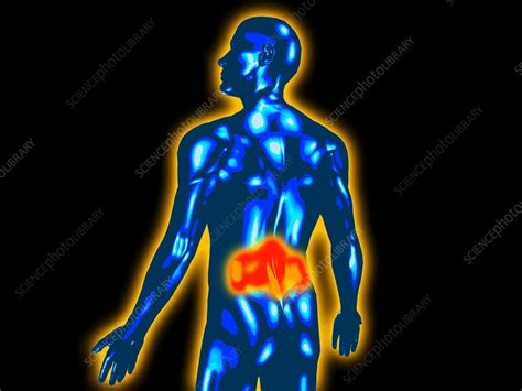 Lower Back Pain Stock Image M382 0519 Science Photo Library