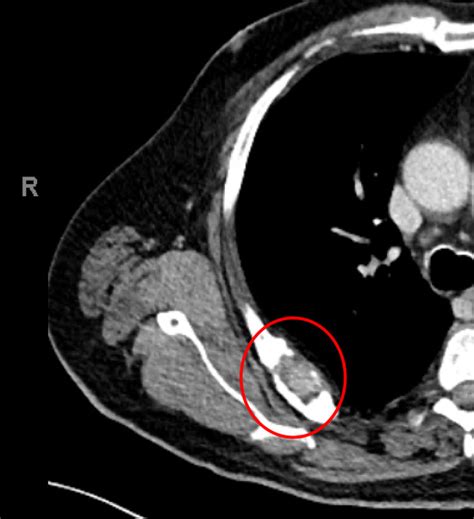 Chest Wall Lumps Rib Injury Clinic