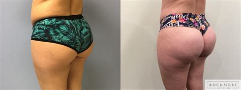 Before And After Brazilian Butt Lift Officiallasopa