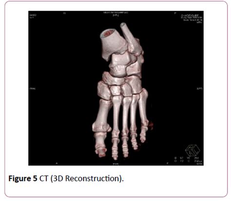 Isolated Medial Cuneiform Fracture: A Case Report and ...