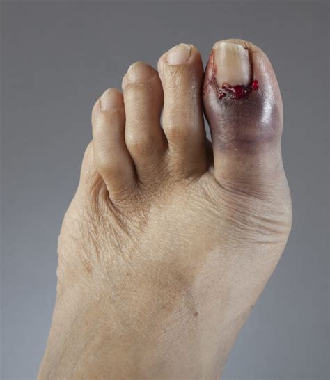 Throbbing Big Toe Pain At Night Causes Symptoms And Best Treatment