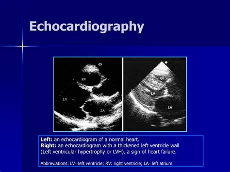 Heart Failure Ecg And Echo Images And Photos Finder