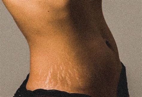 STRETCH MARKS In 2020 Body Positive Photography Body Positivity