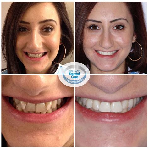 Smile Gallery Before And After Dental Photos Smile Makeovers York My