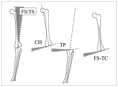 Optimizing Femorotibial Alignment In High Tibial Osteotomy Cjs