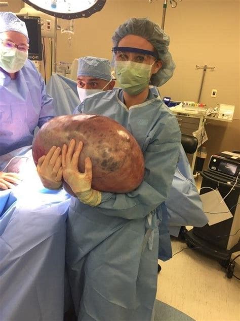 It's not particularly exciting or new. A Woman With An Undetected 50lb Ovarian Cyst Was Told To ...