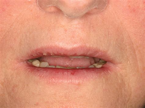 Exfoliative Cheilitis And Lip Damage Registered Dental Hygienist Rdh