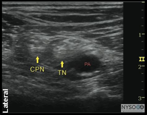 There are many approaches to block the sciatic nerve. Ultrasound Guided Popliteal Sciatic Block - NYSORA The New ...