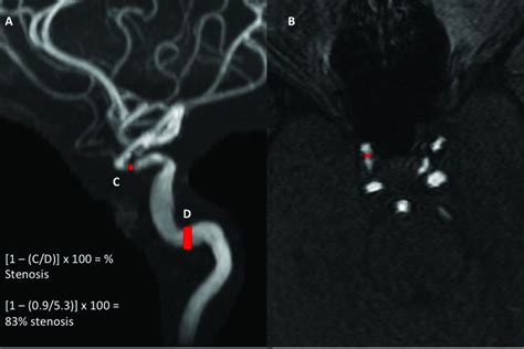 Quantifying Intracranial Internal Carotid Artery Stenosis On Mr