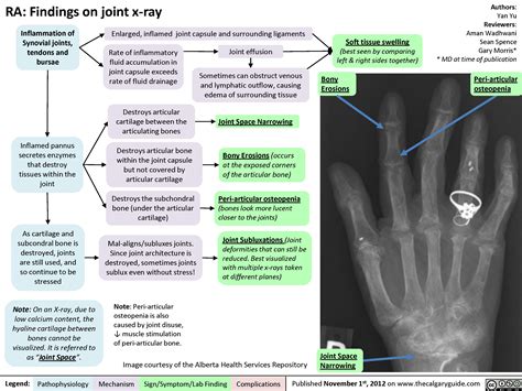 Rheumatoid Arthritis Ra X Ray Features Soft Grepmed