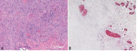 Figure 2 From Subcutaneous Benign Fibrous Histiocytoma Showing Nerve