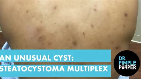 Tbt Cyst Excision On Upper Back Oozy Offerings Dr Pimple Popper