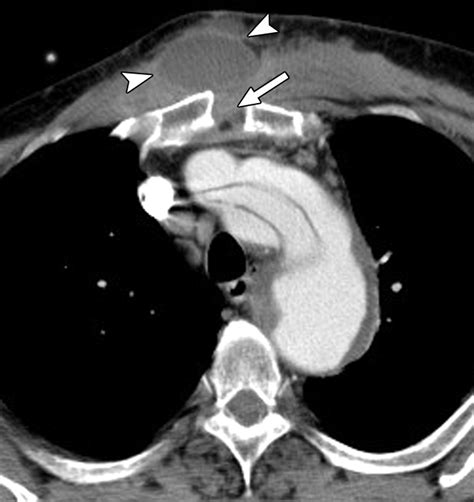 Mdct Angiography After Open Thoracic Aortic Surgery Pearls And
