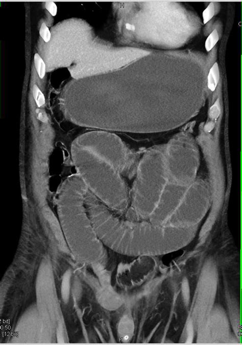 Small Bowel Obstruction Due To A Distal Hernia In Rlq Small Bowel