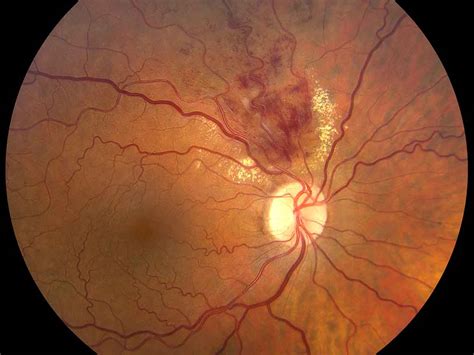 Retinal Vein Occlusion Mr Anish Shah Frcophth