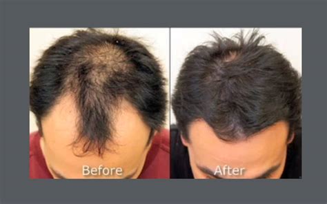 NeoGraft Hair Restoration In Richmond VA Lewis Plastic Surgery