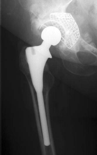 Two Months Post Cemented Acetabular Revision The Femoral Component