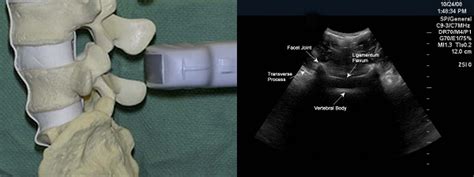 Ob Epidural Tip Student Doctor Network