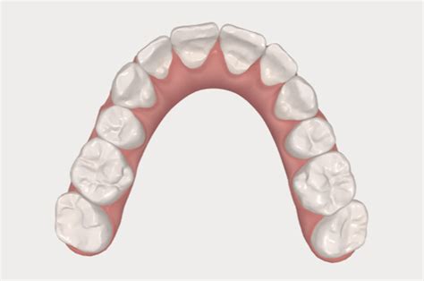 Invisalign Teeth Straightening Simulation Dentist Leeds Fhdc