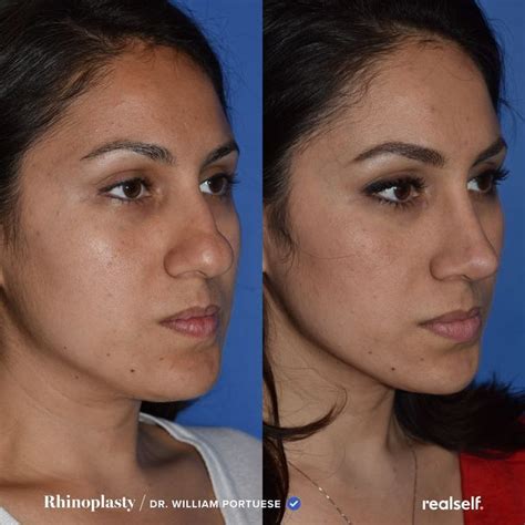 8 Rhinoplasty Recovery Rules You Should Always Follow Realself News