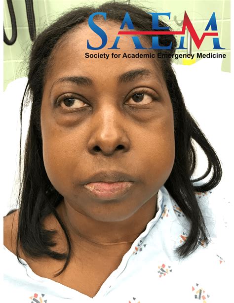 Saem Clinical Image Series Facial Edema Med Tac International Corp