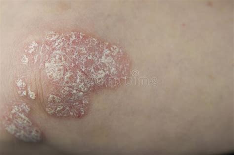 Psoriasis On The Skin Of The Elbow Of A Young Woman In A White T Shirt