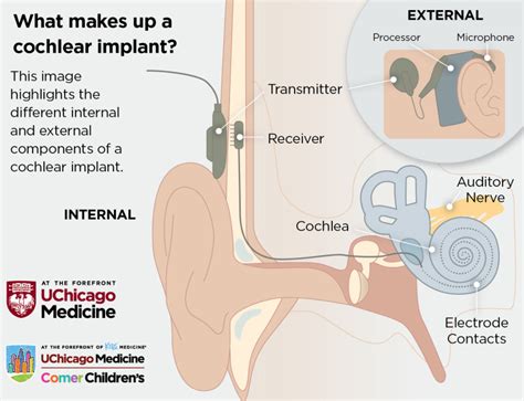 Parts Of A Cochlear Implant Diagram