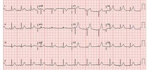 A Case Report Acute Myocardial Infarction In A 29 Year Old Male Emra