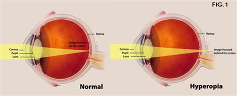 Long Sightedness Hyperopia