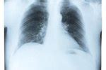 With slight bruises in the ribs, the symptoms can subside improve a lot for about two weekshowever, if you have a severe. How Does a Broken Rib Heal? | eHow