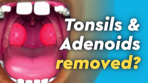 Tonsils And Adenoids Surgery Youtube
