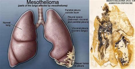 Malignant pleural mesothelioma (mpm), the most common type, is the. Pin on Mesothelioma