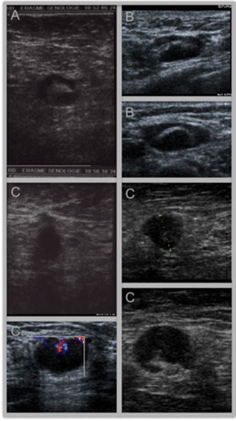 Preoperative Axillary Lymph Node Staging By Ultrasound Guided Cytology