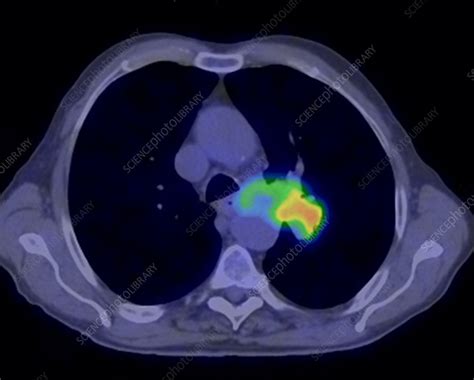 Lung Cancer Ct And Pet Scan Stock Image C0166769 Science Photo