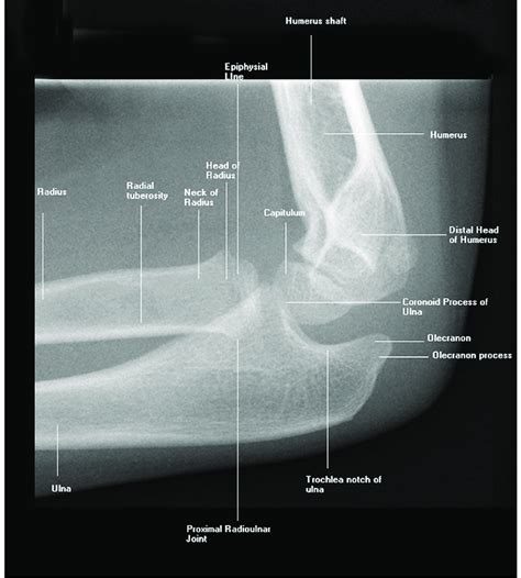 Typical Pediatric Elbow Radiograph The Radiologic Anatomy Of A