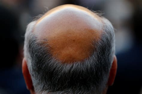 Researchers May Have Baldness Cure—for Some At Least