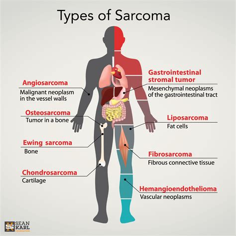 Soft Tissue Sarcoma Types