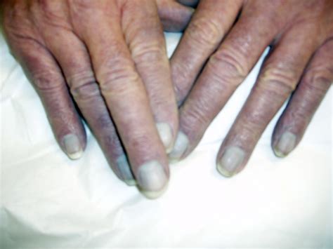 cyanosis fingernails