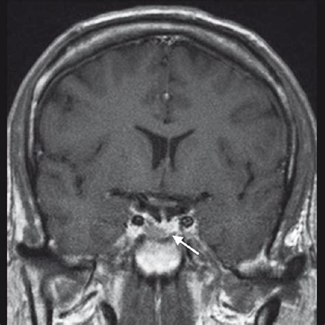 mri scan with gadolinium illustrates a pituitary macroadenoma within a download scientific