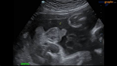 Genital Boy 30 Weeks 700x395 Pregnancy Scan Breast Scan Pelvic Scan