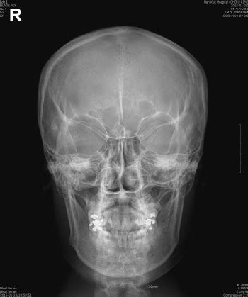 I'm not sure just what that 6.5 mm fragment is, reported sturdivan. skull & facial 방사선촬영법 / 방사선검사메뉴얼 : 네이버 블로그