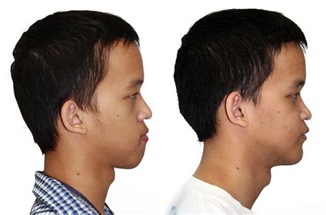 Facial Asymmetry Correction Corrective Jaw Surgery Dr Antipov