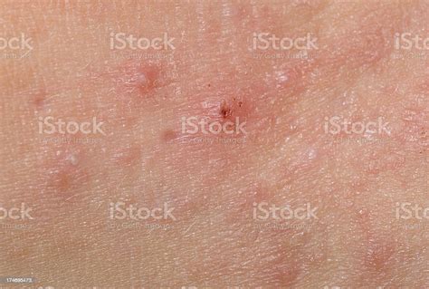 Shown Here Is A Bumpy Red Skin Rash On A Childaas Armsee Other