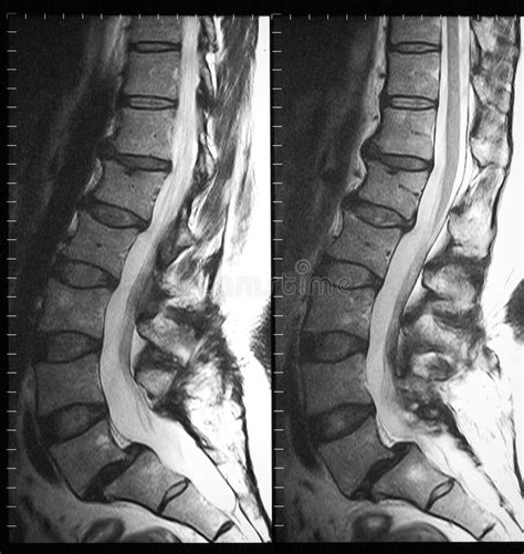 Mri Of Lumbar Spine In Sagittal Plane Royalty Free Stock Photos Image