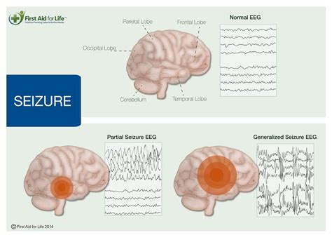 Seizures Convulsions And Epilepsy And How To Manage Them