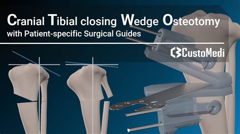 Cranial Tibial Closing Wedge Osteotomyctwo With Patient Specific