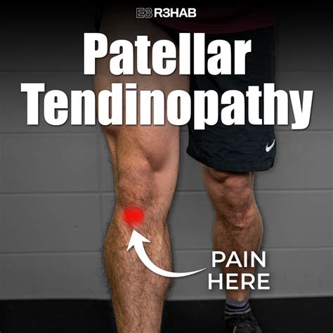 Patellar Tendinopathy E3 Rehab