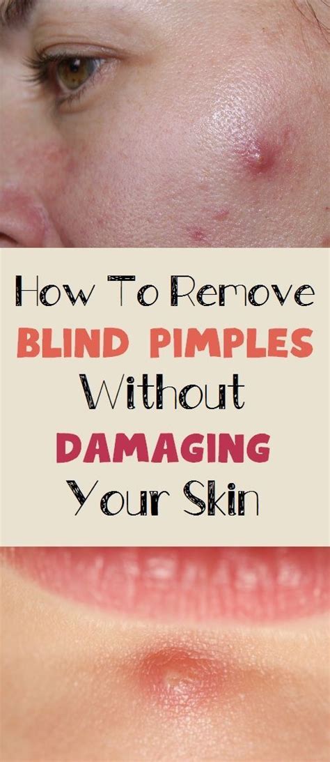How To Remove Blind Pimples Without Damaging Your Skin Blind Pimple
