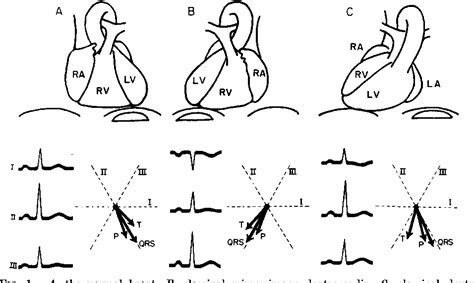 Figure 1 From The Syndrome Of Dextroversion Of The Heart Semantic Scholar